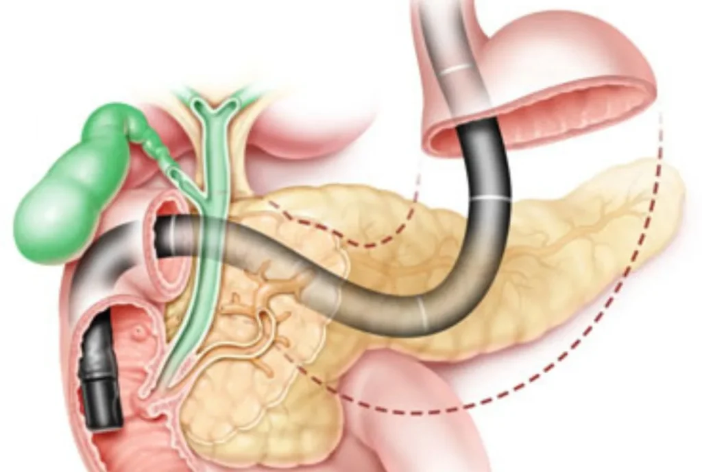 What Are the Common Causes That Require ERCP Treatment